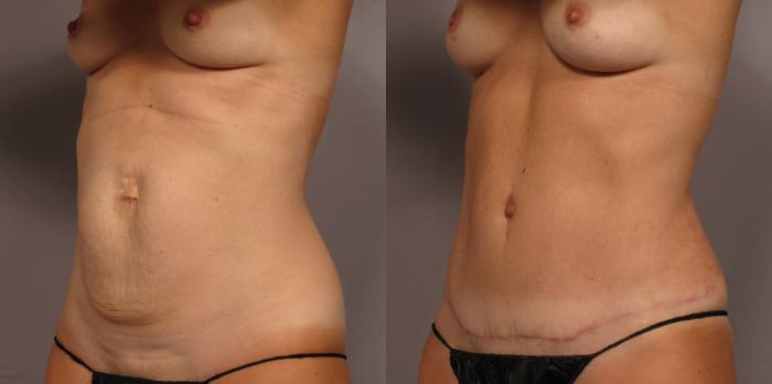 Before Mommy Makeover, Left Oblique View
