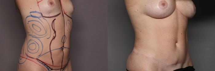 Before Mommy Makeover, Right Oblique View