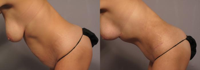 Before Mommy Makeover, Left Side Lean View
