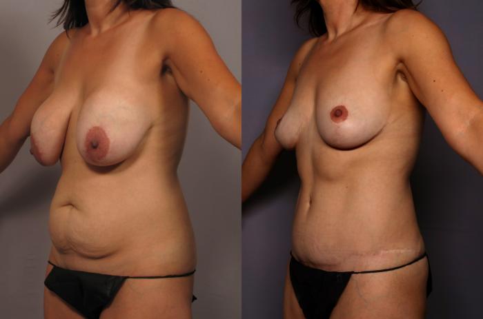 Before Mommy Makeover, Left Oblique View