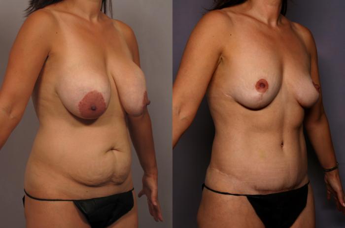 Before Mommy Makeover, Right Oblique View
