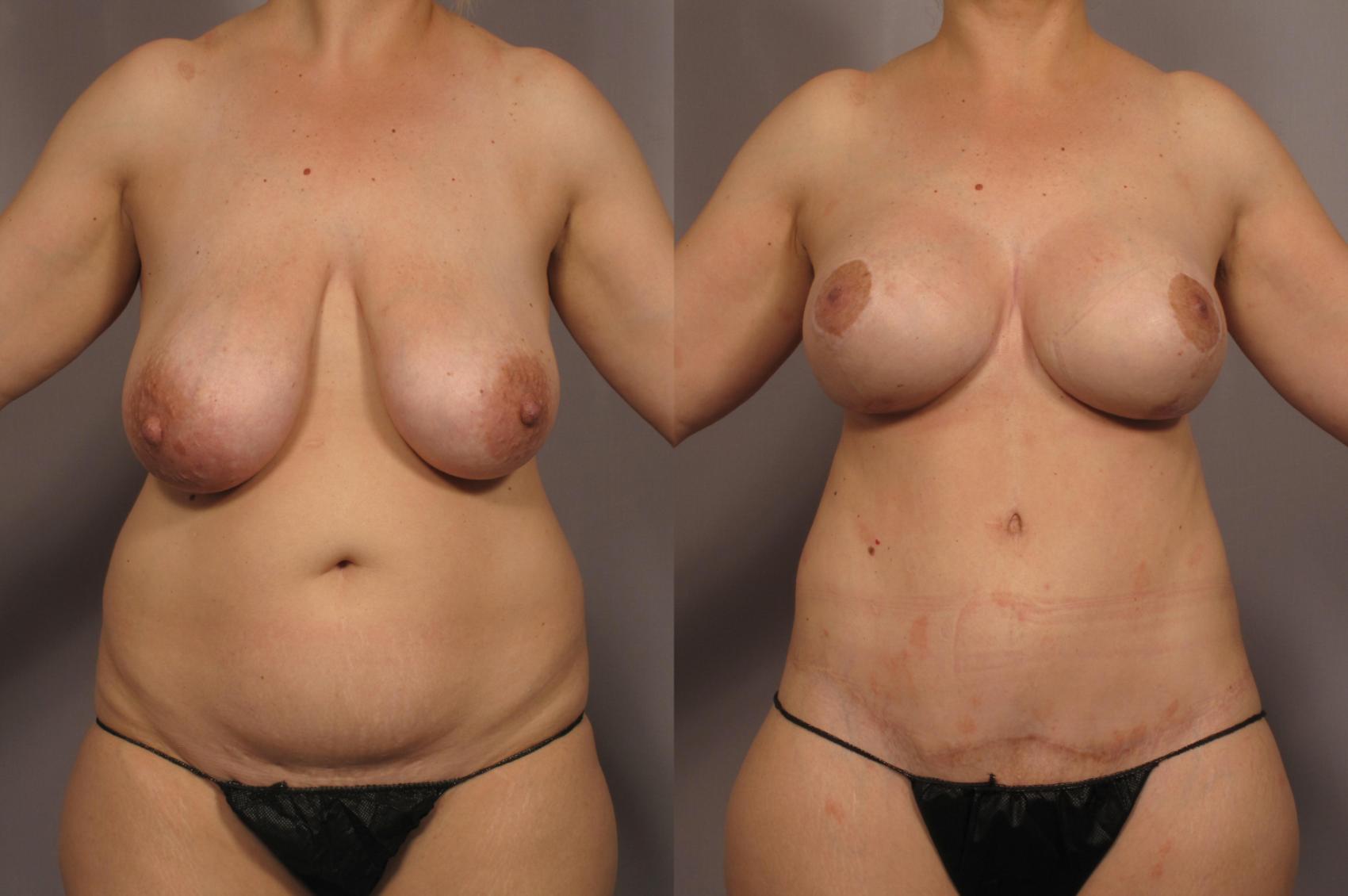 Before Mommy Makeover, Front View