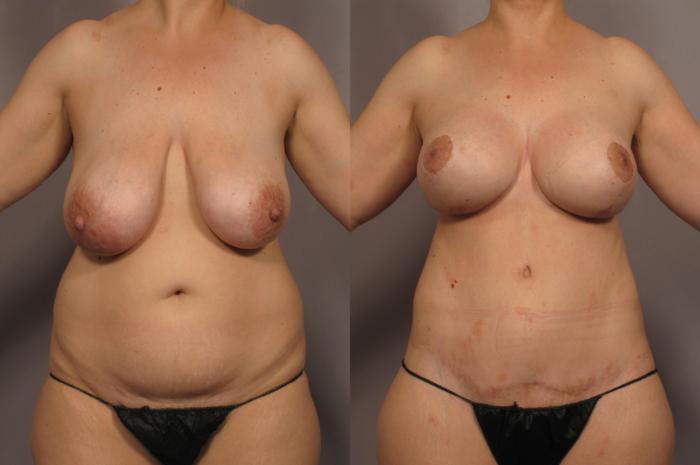 Before Mommy Makeover, Front View