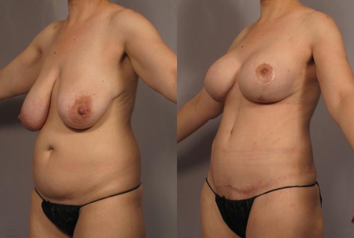 Before Mommy Makeover, Left Oblique View