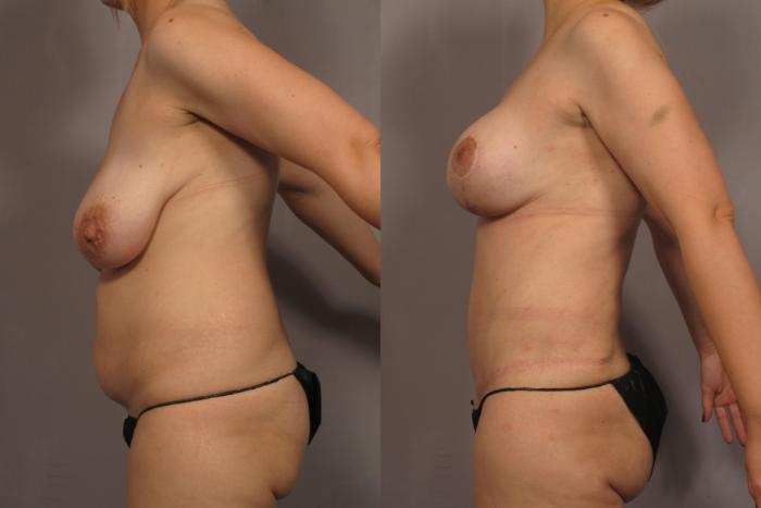 Before Mommy Makeover, Left Side View