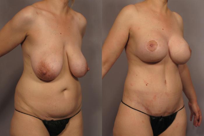 Before Mommy Makeover, Right Oblique View
