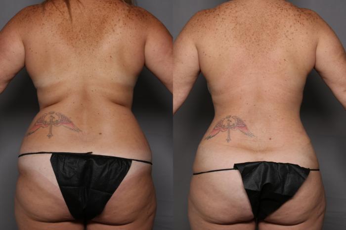 Before Mommy Makeover by Dr. Hasen, back view