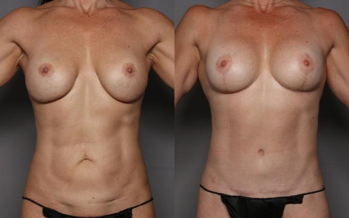 Before Mommy Makeover by Dr. Hasen, front view