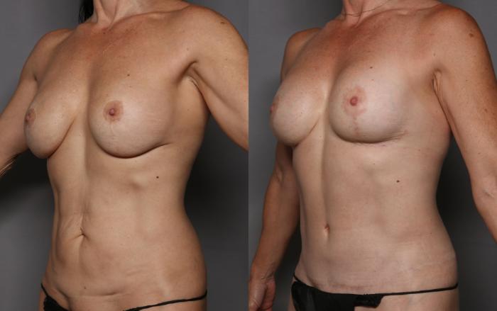 Before Mommy Makeover in Naples by Dr. Hasen, left oblique view