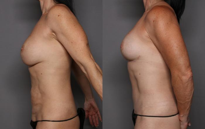 Before Mommy Makeover in Naples by Dr. Hasen, left side view