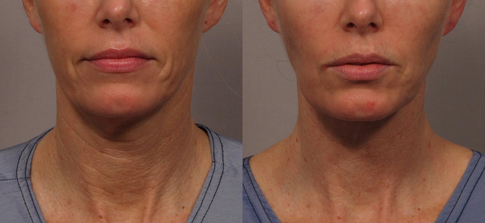 Front view of a woman before MyEllevate Neck Lift