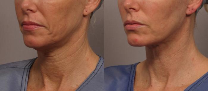 Left Oblique view of a woman before MyEllevate Neck Lift