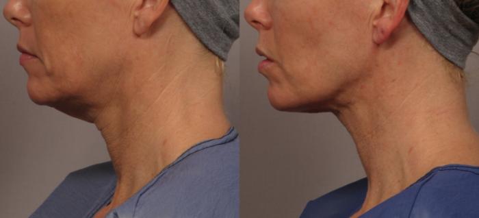 Left side view of a woman before MyEllevate Neck Lift