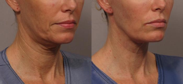Left Right Oblique view of a woman before MyEllevate Neck Lift