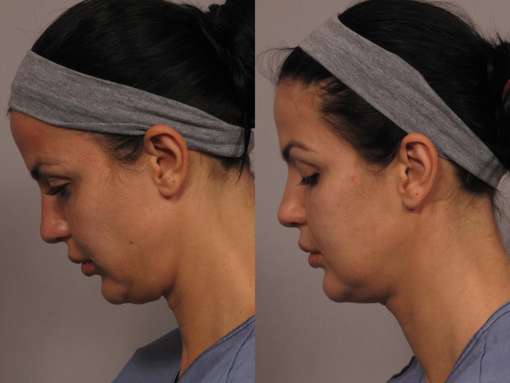 Skin tightening Neck