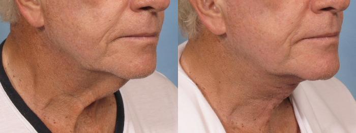 Before & After Neck Lift Case 187 View #2 View in Naples and Ft. Myers, FL