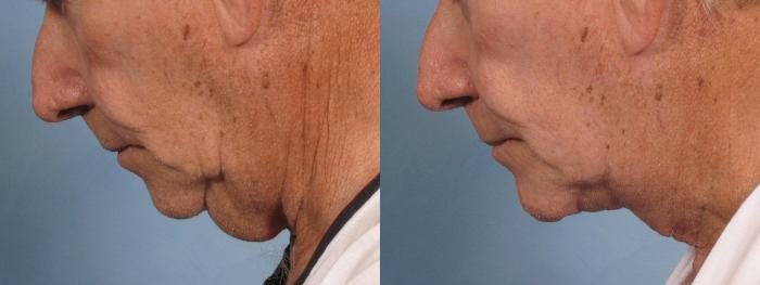 Before & After Neck Lift Case 187 View #3 View in Naples and Ft. Myers, FL