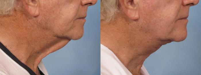 Before & After Neck Lift Case 187 View #4 View in Naples and Ft. Myers, FL