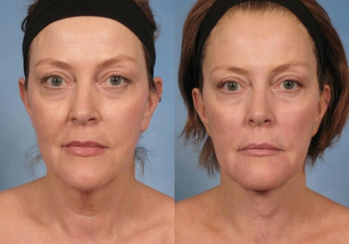 Before & After Neck Lift Case 188 View #1 View in Naples and Ft. Myers, FL