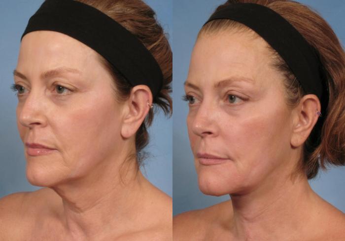 Before & After Neck Lift Case 188 View #2 View in Naples and Ft. Myers, FL