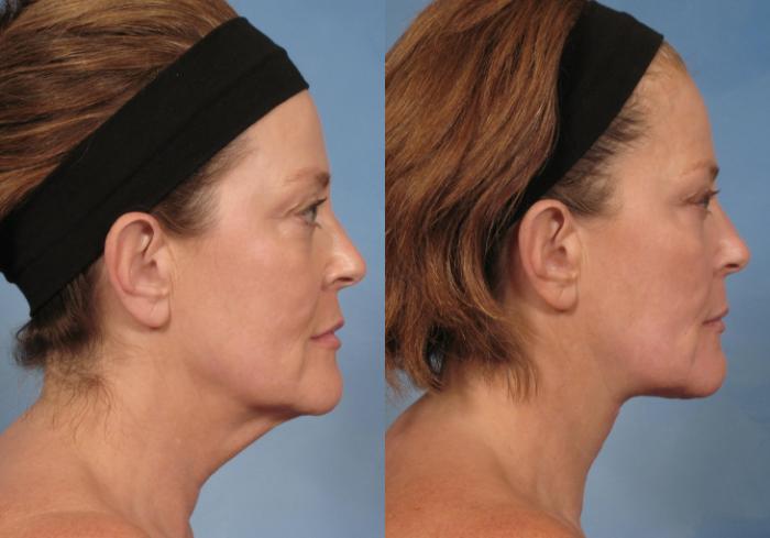 Before & After Neck Lift Case 188 View #3 View in Naples and Ft. Myers, FL