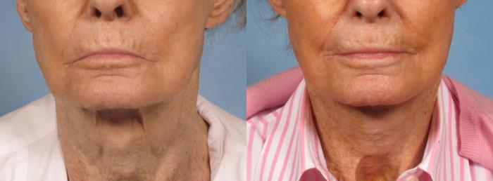 Before & After Neck Lift Case 189 View #1 View in Naples and Ft. Myers, FL