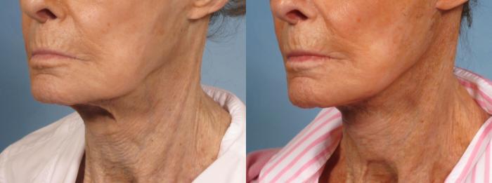 Before & After Neck Lift Case 189 View #2 View in Naples and Ft. Myers, FL