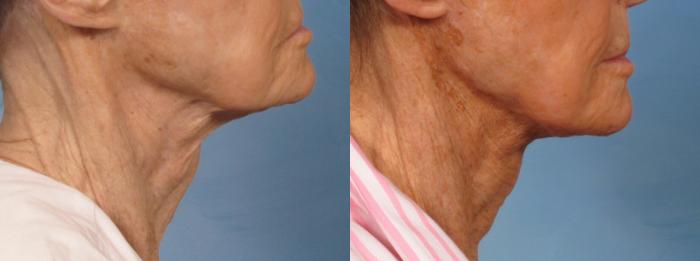 Before & After Neck Lift Case 189 View #3 View in Naples and Ft. Myers, FL