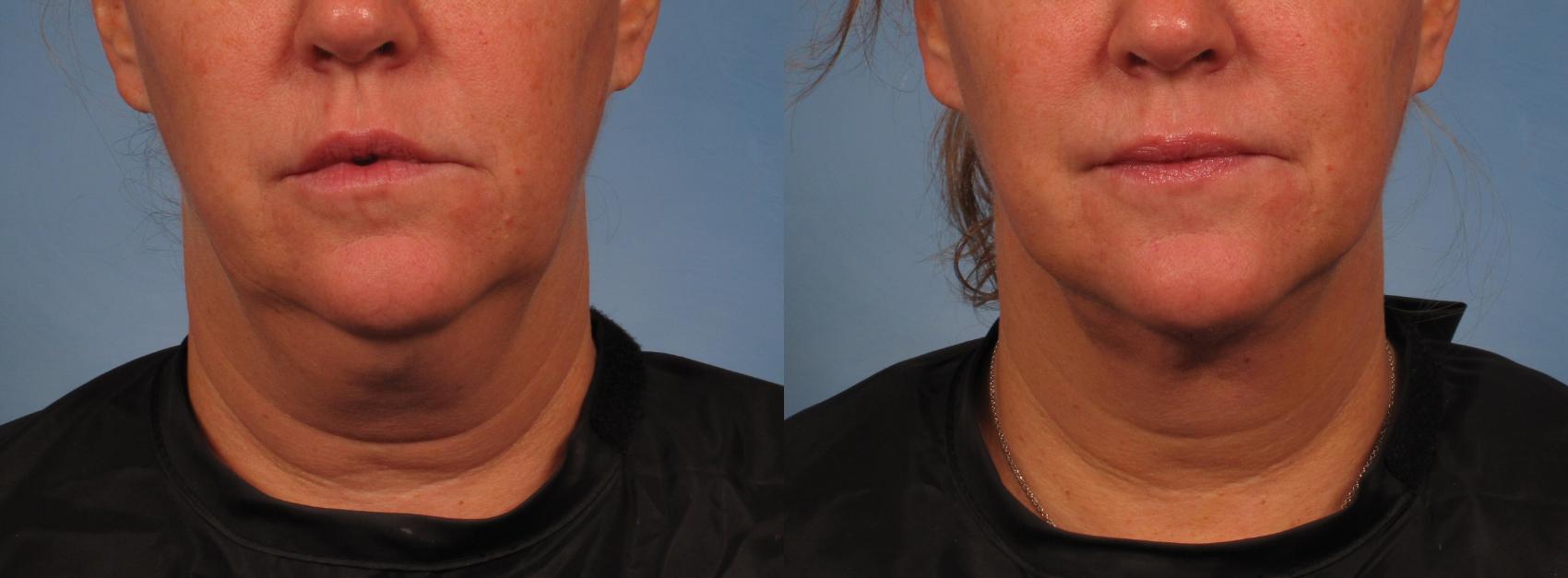 Before & After Neck Lift Case 276 View #1 View in Naples and Ft. Myers, FL