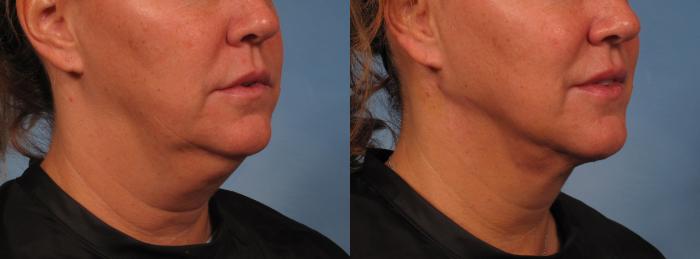 Before & After Neck Lift Case 276 View #2 View in Naples and Ft. Myers, FL