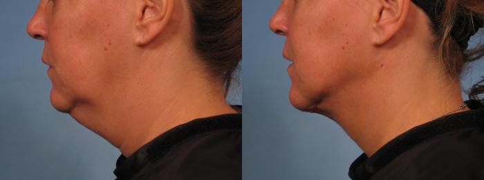 Before & After Neck Lift Case 276 View #3 View in Naples and Ft. Myers, FL