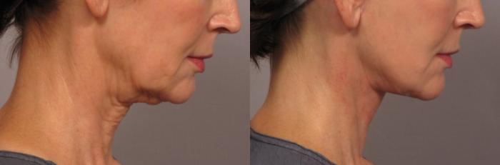 Before & After Neck Lift Case 301 View #1 View in Naples and Ft. Myers, FL