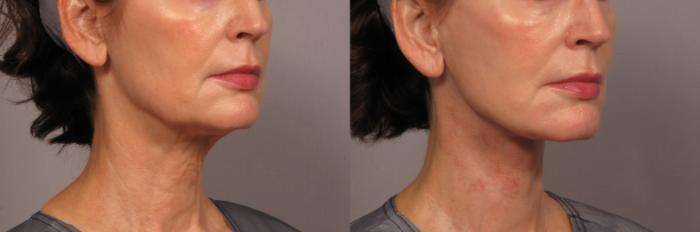 Before & After Neck Lift Case 301 View #2 View in Naples and Ft. Myers, FL