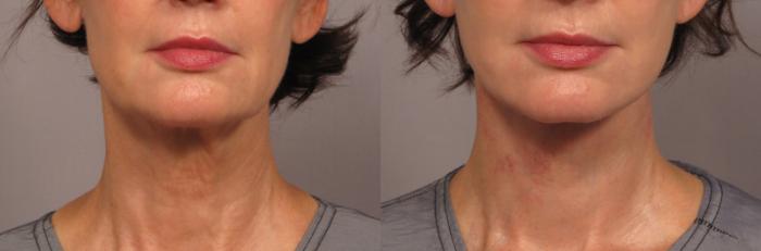 Before & After Neck Lift Case 301 View #3 View in Naples and Ft. Myers, FL