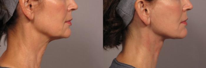 Before & After Neck Lift Case 301 View #4 View in Naples and Ft. Myers, FL