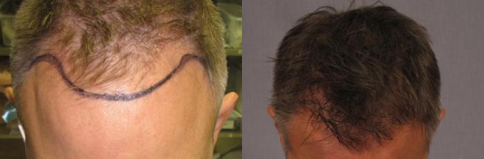 Before & After NeoGraft Hair Transplant Case 253 View #1 View in Naples and Ft. Myers, FL