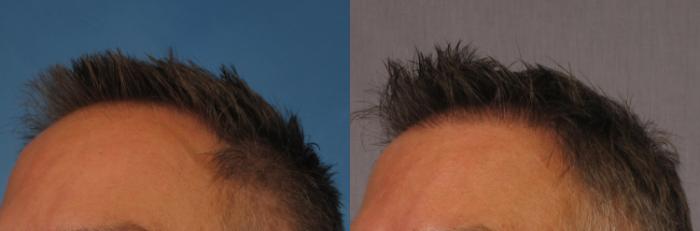 Before & After NeoGraft Hair Transplant Case 253 View #2 View in Naples and Ft. Myers, FL