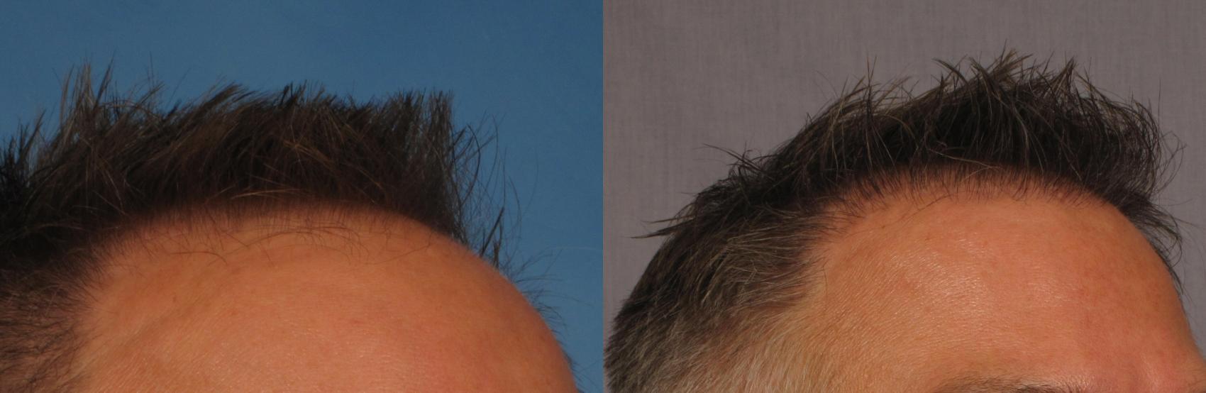 Before & After NeoGraft Hair Transplant Case 253 View #3 View in Naples and Ft. Myers, FL