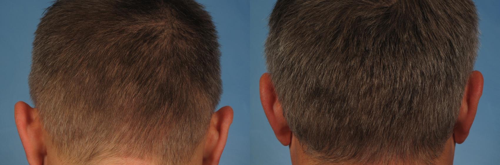 Before & After NeoGraft Hair Transplant Case 253 View #4 View in Naples and Ft. Myers, FL