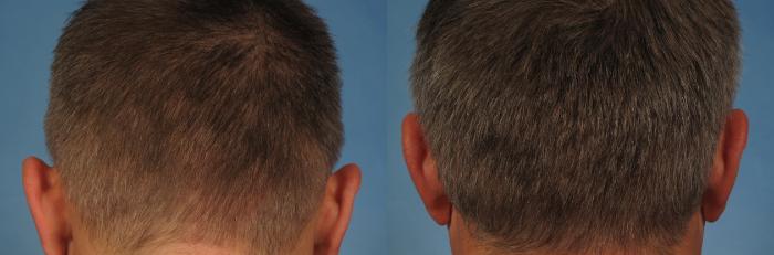 Before & After NeoGraft Hair Transplant Case 253 View #4 View in Naples and Ft. Myers, FL