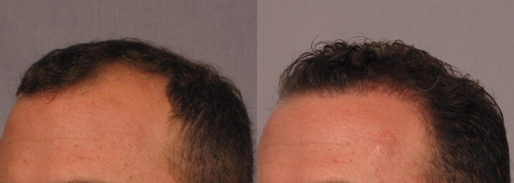 Before & After NeoGraft Hair Transplant Case 298 View #2 View in Naples, FL
