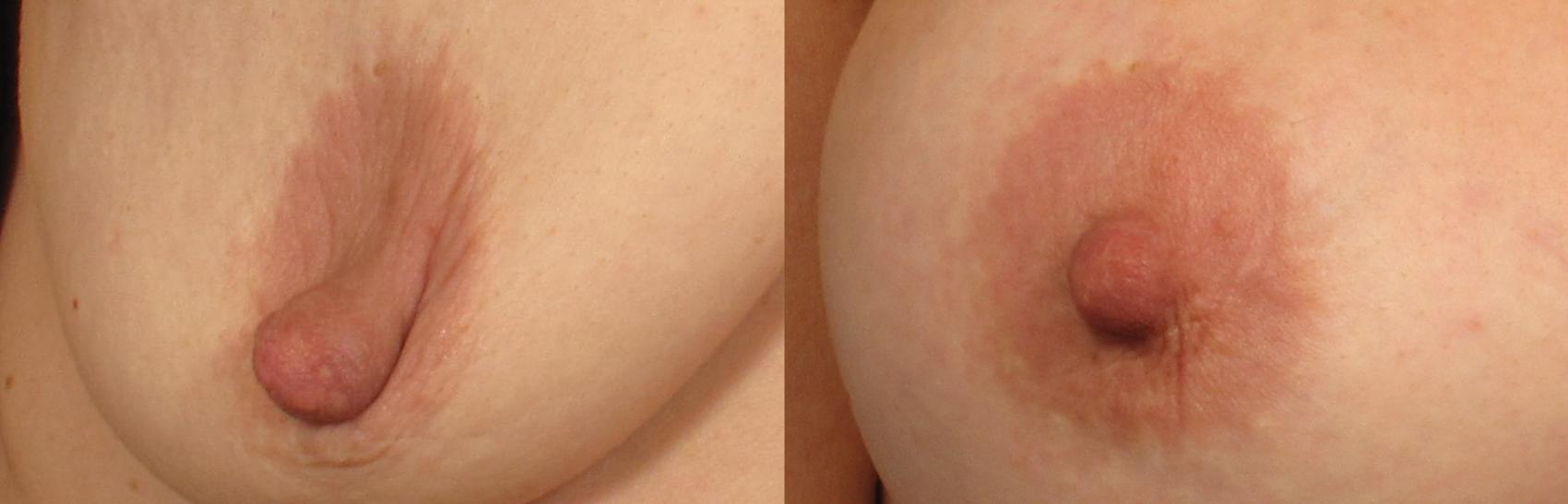 Before & After Nipple Reduction Case 307 View #1 View in Naples and Ft. Myers, FL