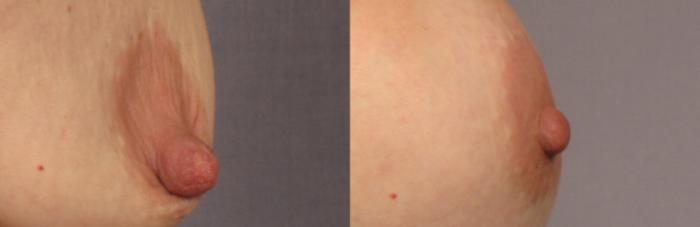 Before & After Nipple Reduction Case 307 View #2 View in Naples and Ft. Myers, FL
