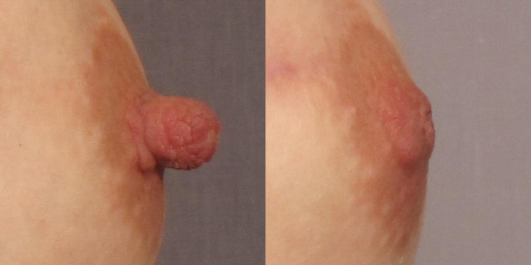 Before & After Nipple Reduction Case 310 View #1 View in Naples and Ft. Myers, FL