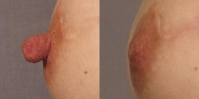 Before & After Nipple Reduction Case 310 View #2 View in Naples and Ft. Myers, FL