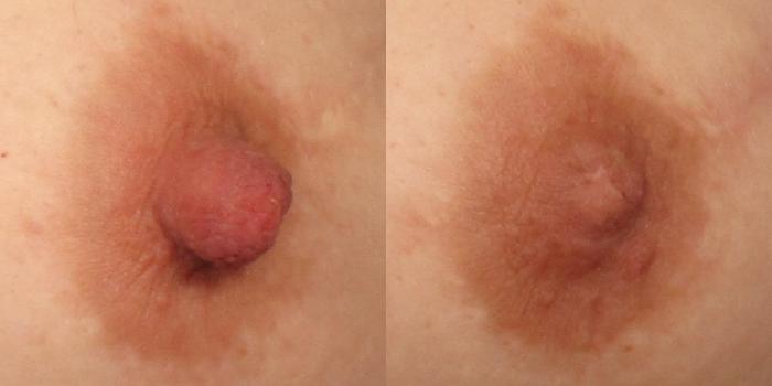 Before & After Nipple Reduction Case 310 View #3 View in Naples and Ft. Myers, FL