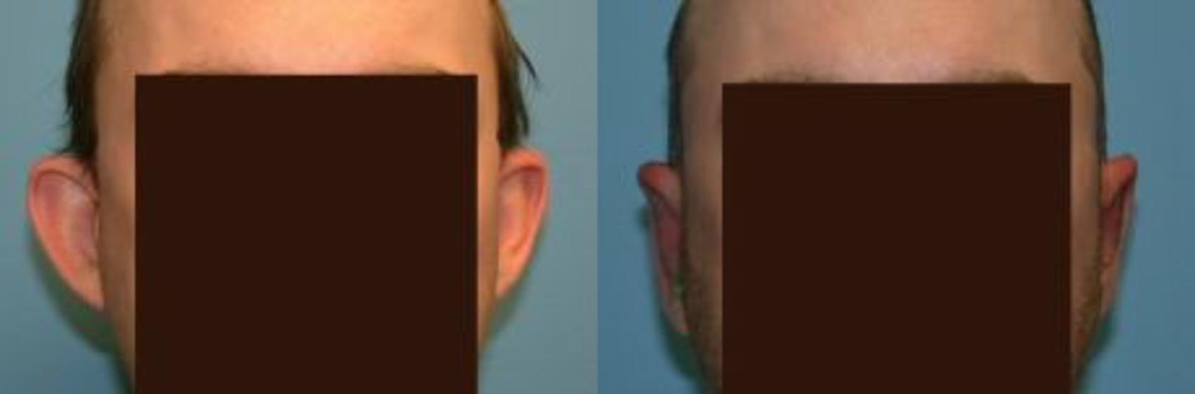 Before & After Otoplasty Case 12 View #1 View in Naples, FL