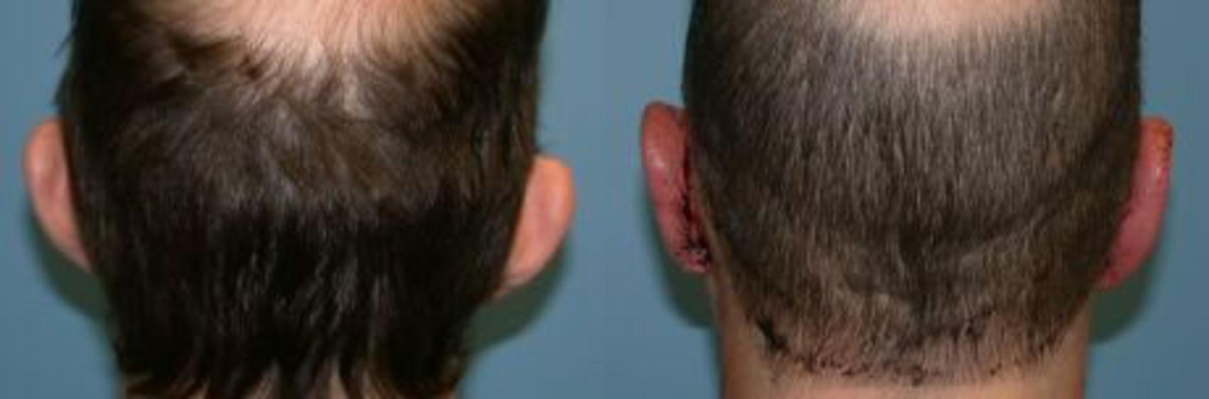 Before & After Otoplasty Case 12 View #2 View in Naples, FL