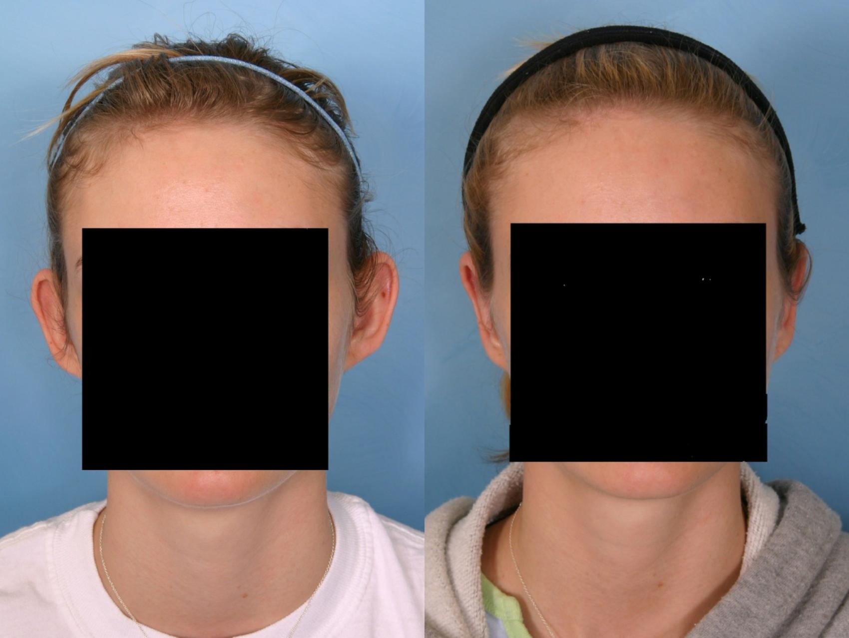 Before & After Otoplasty Case 23 View #2 View in Naples, FL