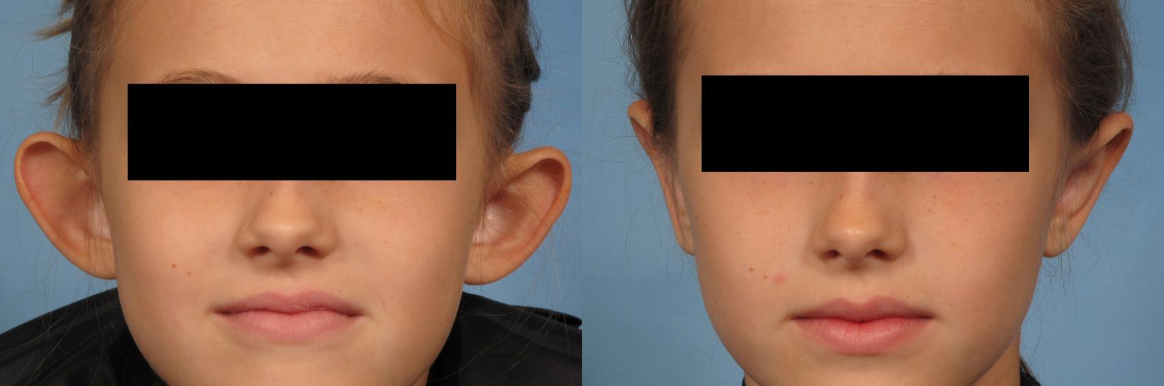 Before & After Otoplasty Case 262 View #1 View in Naples, FL